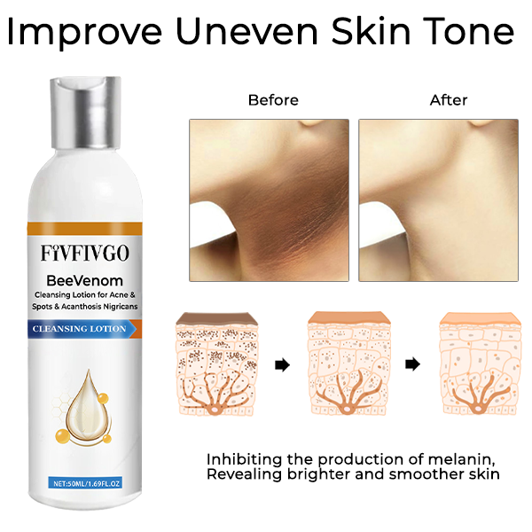 Fivfivgo™ BeeVenom Cleansing Lotion for Acne & Spots & Acanthosis Nigricans