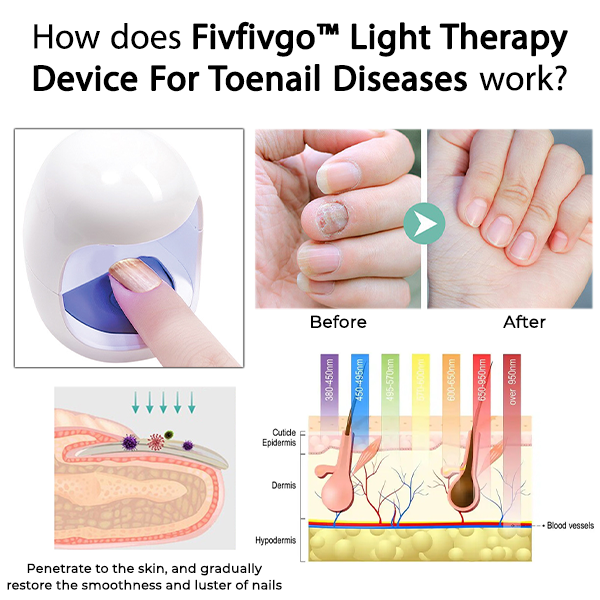 Fivfivgo™ Appareil de luminothérapie pour les maladies des ongles de pied