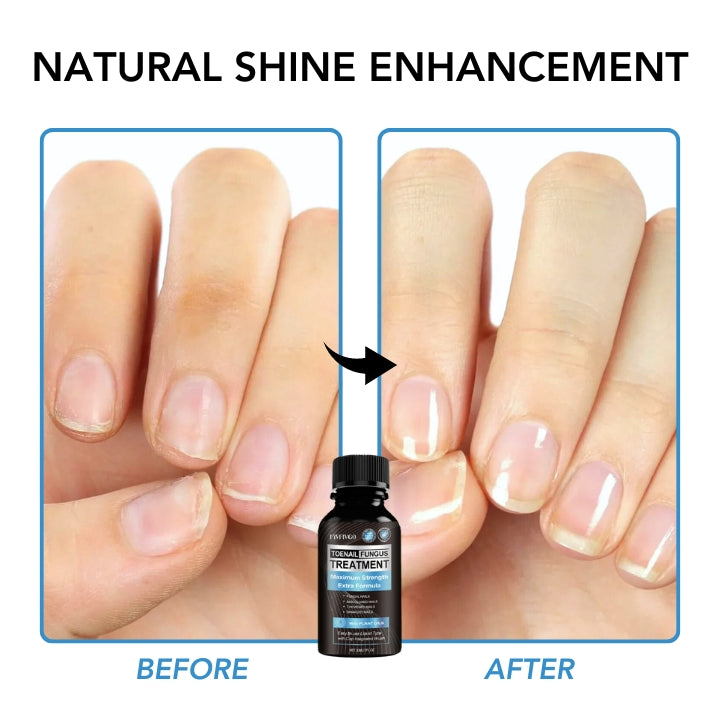 Fivfivgo™ Maximale Gel de traitement strength onychomadesis