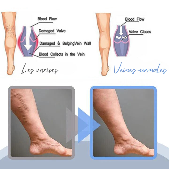 Fivfivgo™ Spray contre les varices