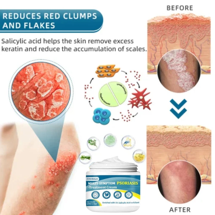 Fivfivgo™ Multi-Symptom-Psoriasis-Behandlungscreme