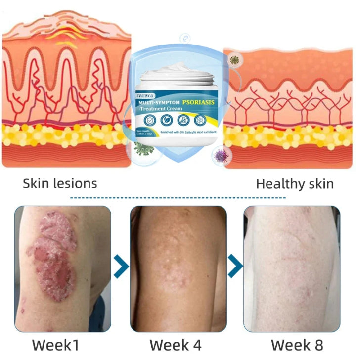 Fivfivgo™ Multi-Symptom-Psoriasis-Behandlungscreme