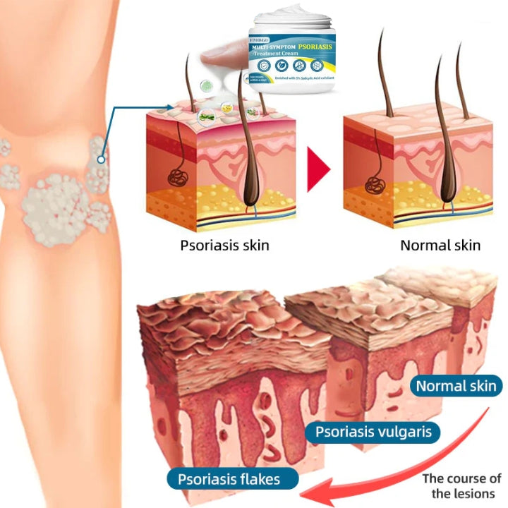 Fivfivgo™ Multi-Symptom-Psoriasis-Behandlungscreme