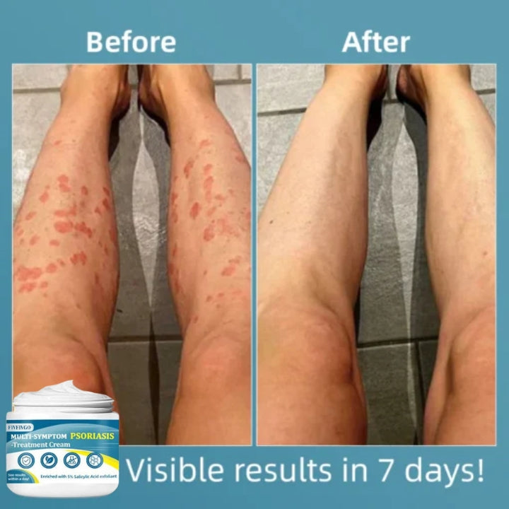 Fivfivgo™ Multi-Symptom-Psoriasis-Behandlungscreme