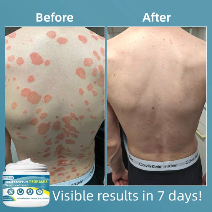 Fivfivgo™ Multi-Symptom-Psoriasis-Behandlungscreme