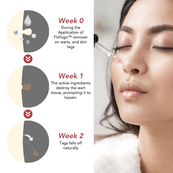 Fivfivgo™ SkinClear Dissolvant d'Étiquettes et de Taupes