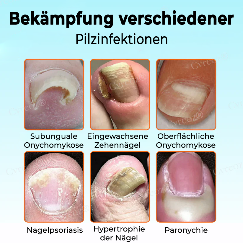 Cvreoz® Nagelstärkungs-Salbe