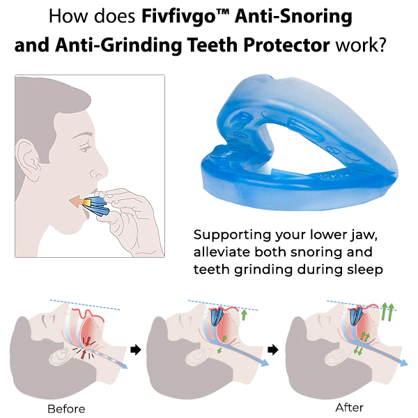 Fivfivgo™ Protecteur de dents anti-ronflement et anti-grincement