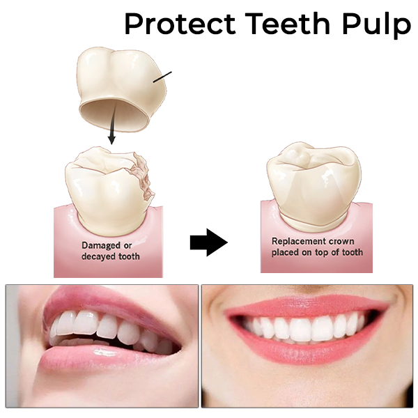 Fivfivgo™ Facettes de couronne dentaires temporaires pour le revêtement des dents molaires antérieures/postérieures