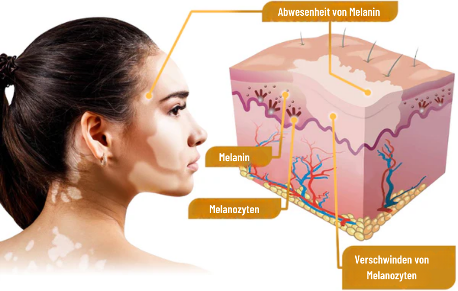 Fivfivgo™ BeeVenom Vitiligo Behandlung Creme