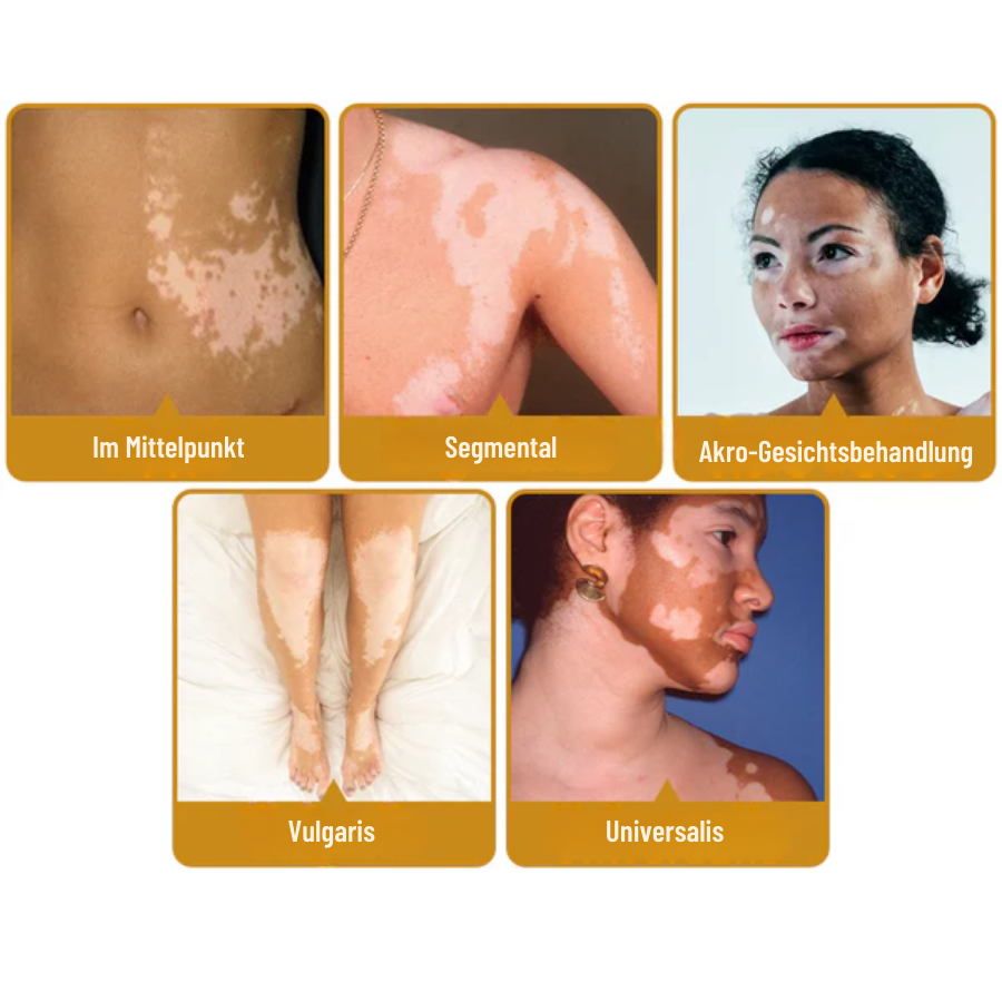 Fivfivgo™ BeeVenom Vitiligo Behandlung Creme