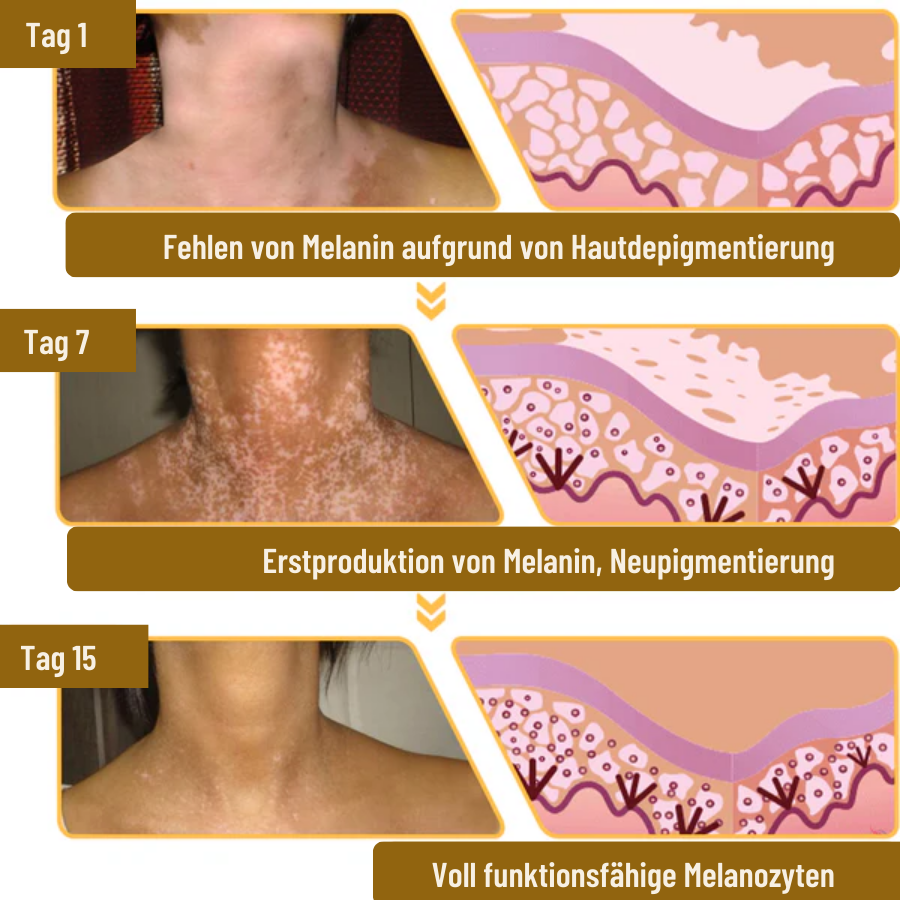 Fivfivgo™ BeeVenom Vitiligo Behandlung Creme