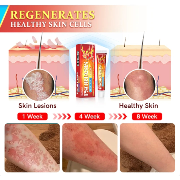 Fivfivgo™ Psoriasis Antibacterial Treatment Cream