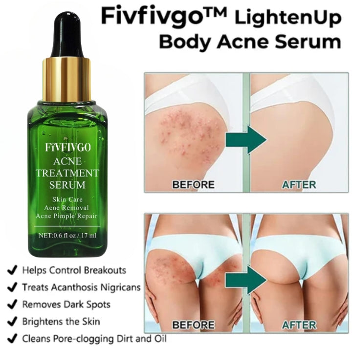 Fivfivgo™ LightenUp Body Acne Serum (for Acne & Spots & Acanthosis Nigricans Removal)