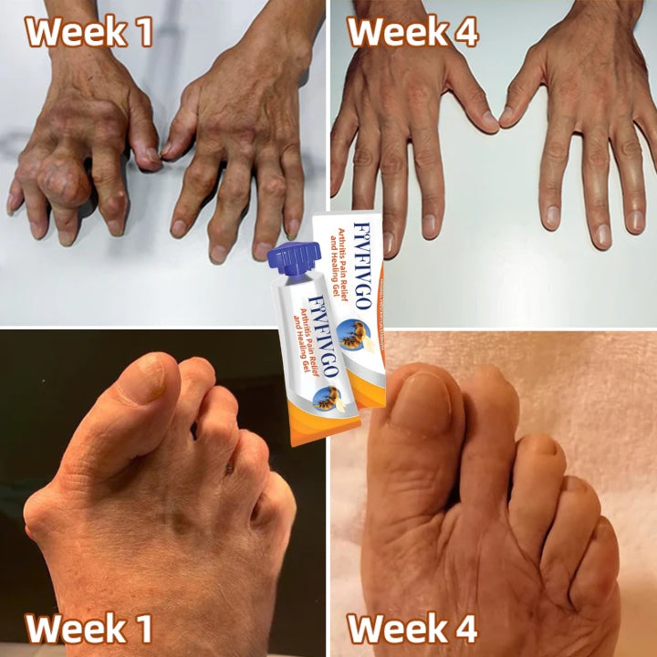 Fivfivgo™ Canadian Bee Venom Alleviating Bone Pain and Repairing Bone Injuries Gel