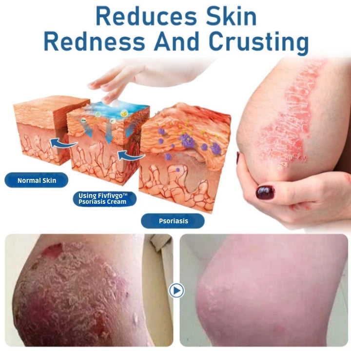 Fivfivgo™ Psoriasis Crème Hydratante et Apaisante