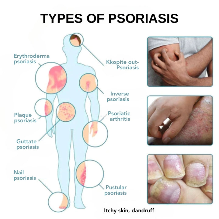 Fivfivgo™ Psoriasis-Behandlungsspray