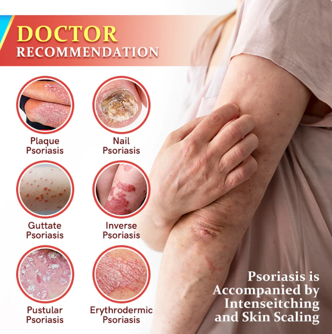 Fivfivgo™ Psoriasis Antibacterial Treatment Cream