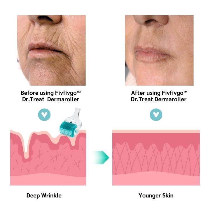 Fivfivgo™ Dermaroller collagène 0,5 mm Dr. Treat PockmarksHeal