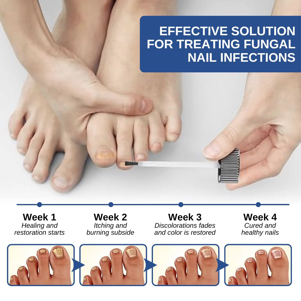 Fivfivgo™ Formule à base de plantes Ongle fongique paronychie traitement