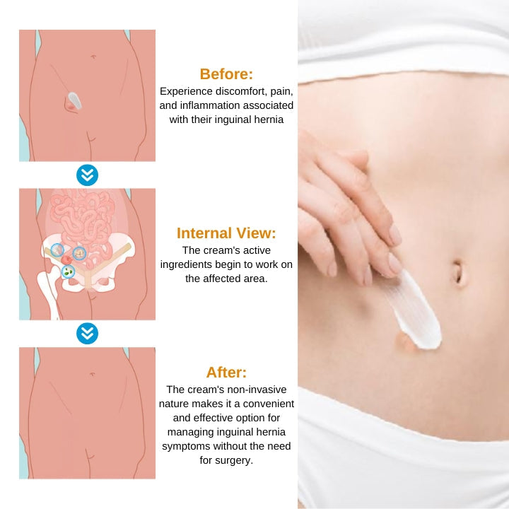 Fivfivgo™ Crème de traitement des hernies inguinales