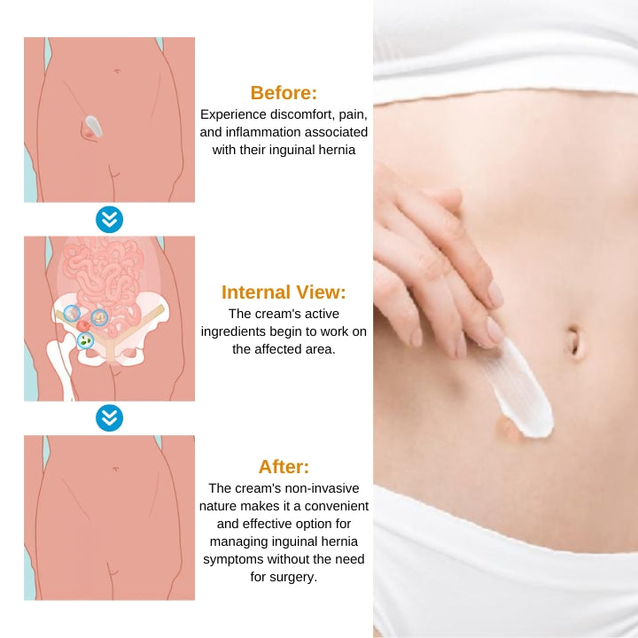 Fivfivgo™ Inguinal Hernia Treatment Cream