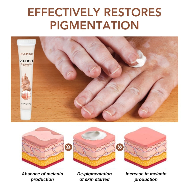 Fivfivgo™ Vitiligo Therapeutische Creme