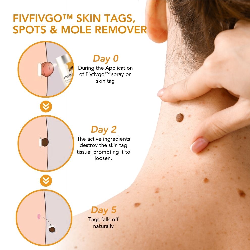 Fivfivgo™ Skin Tags, Spots & Mole Remover