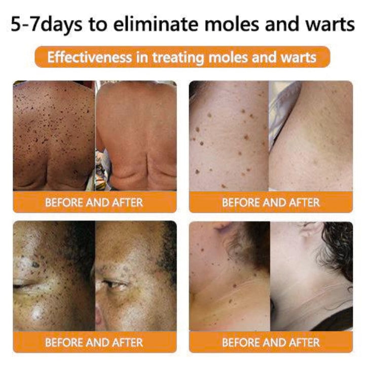 Fivfivgo™ Bienengift Mole & Warze Behandlung Creme