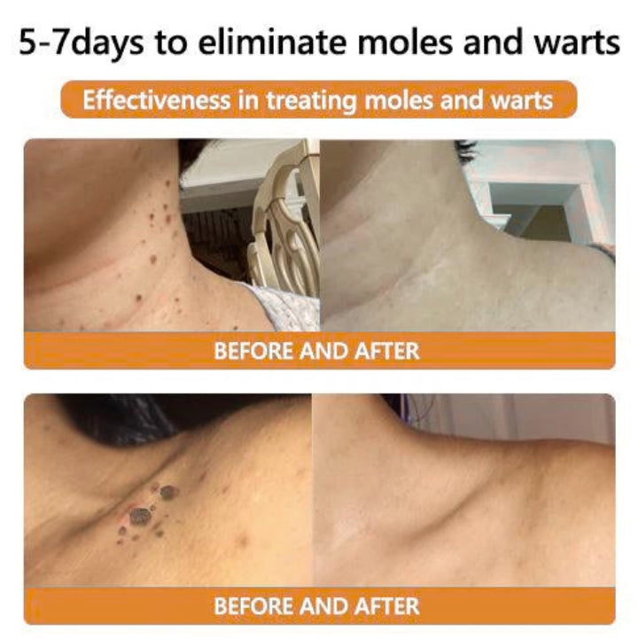 Fivfivgo™ Bee Venom Mole & Wart Treatment Cream