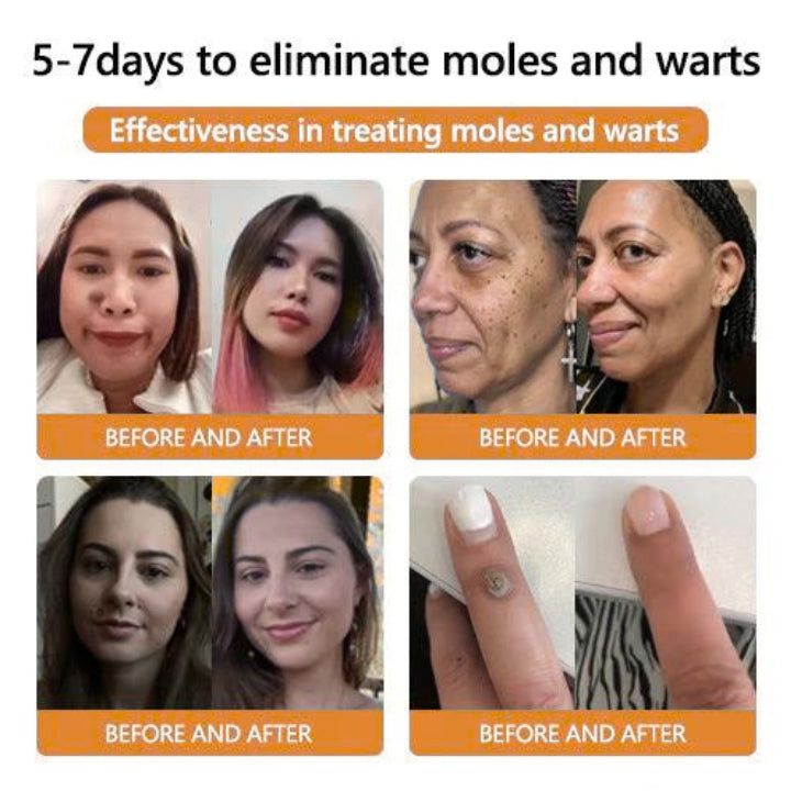 Fivfivgo™ Bee Venom Mole & Wart Treatment Cream
