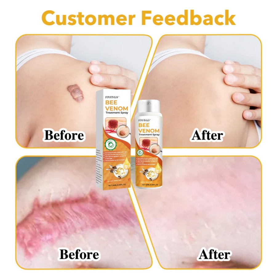 Fivfivgo™ Bee Venom Therapy Spray (Dermatest Certification)