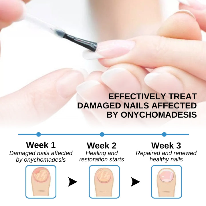 Fivfivgo™ Maximum Strength Onychomadesis Treatment Gel