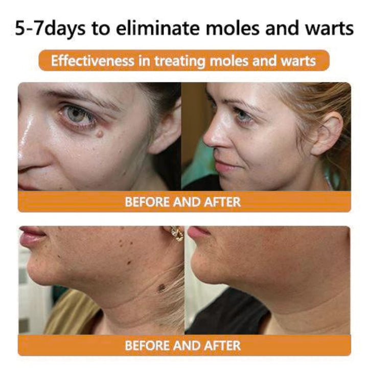 Fivfivgo™ Bee Venom Mole & Wart Treatment Cream