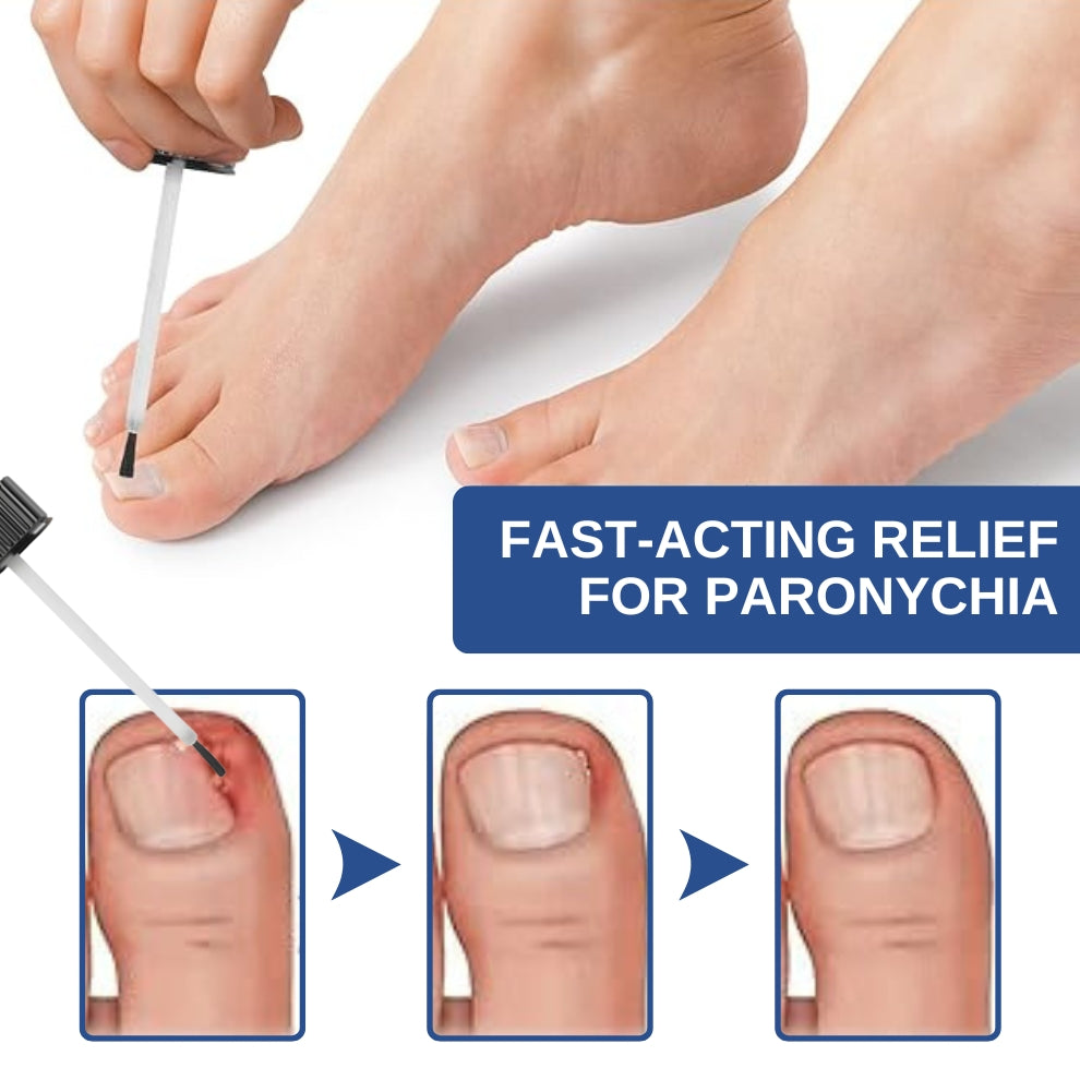 Fivfivgo™ Pflanzliche Formel Nagelpilz Paronychie Behandlung