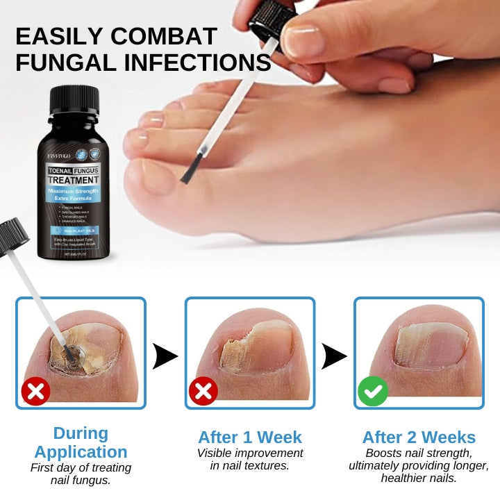 Fivfivgo™ Maximale Gel de traitement strength onychomadesis