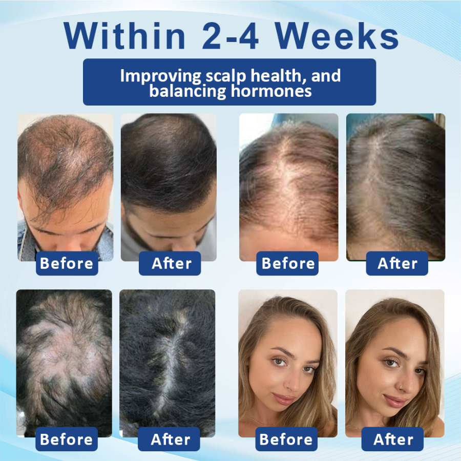 Fivfivgo™ Alopecia Recovery Hair Regrowth Cream