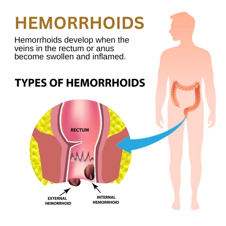 Fivfivgo™ Hemorrhoid Relief Cream