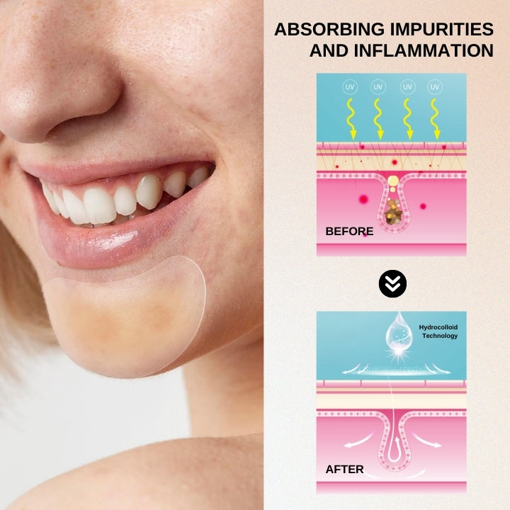 Fivfivgo™ Hydrogel Acne Patch