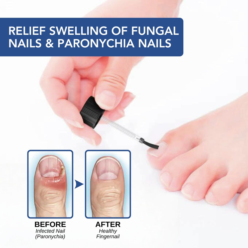 Fivfivgo™ Formule à base de plantes Ongle fongique paronychie traitement