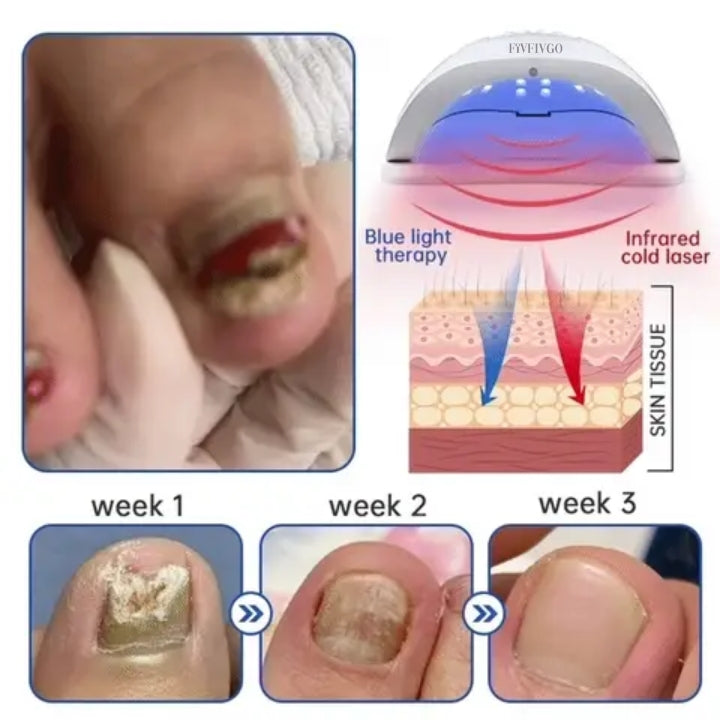 Fivfivgo™ PureNail Fungus Laser Therapy Device