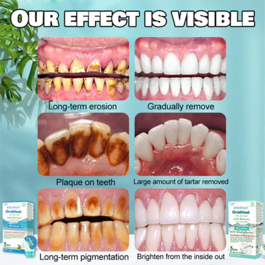 Fivfivgo™ OralHeal Mouthwash - removes calculus, whitens teeth, prevents and treats mouth ulcers, cavities, eliminates bad breath