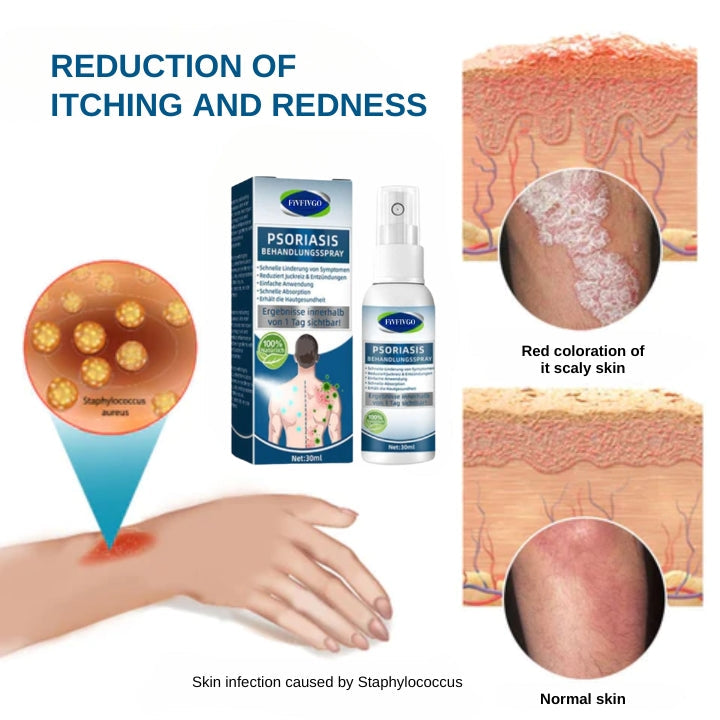 Fivfivgo™ Spray de Traitement du Psoriasis