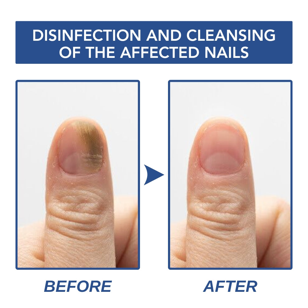 Fivfivgo™ Herbal Formula Fungal Nail Paronychia Treatment