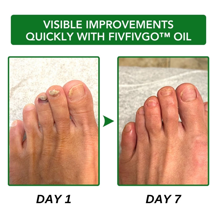 Fivfivgo™ FullNail Tea Tree Essential Oil