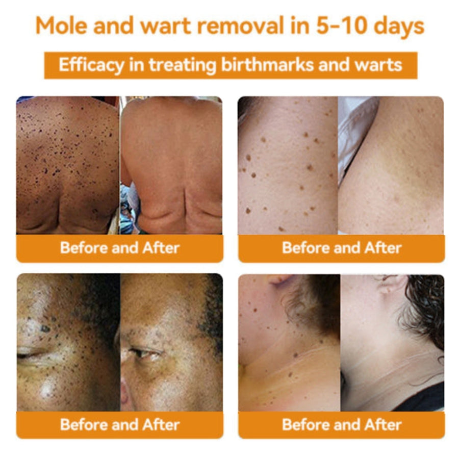 Fivfivgo™ Bee Venom Warts & Blemish Remover