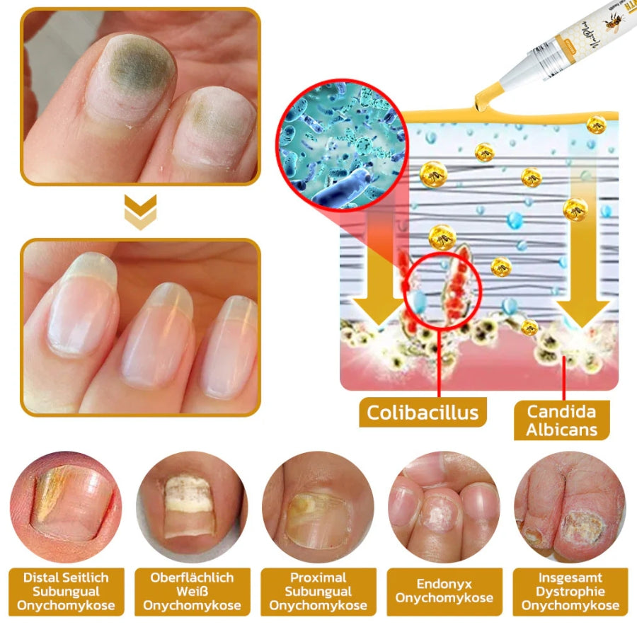 Fivfivgo™ NailPlus Starkes Bienengift 7 Tage Wachstum Nagelgel