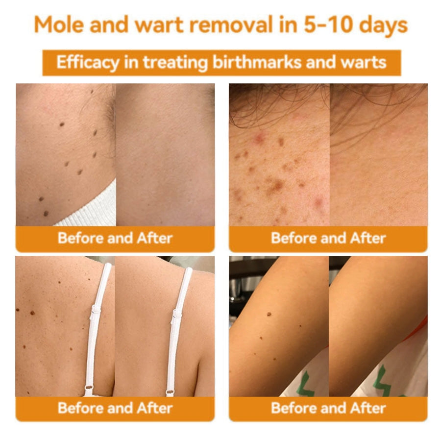 Fivfivgo™ Bee Venom Warts & Blemish Remover
