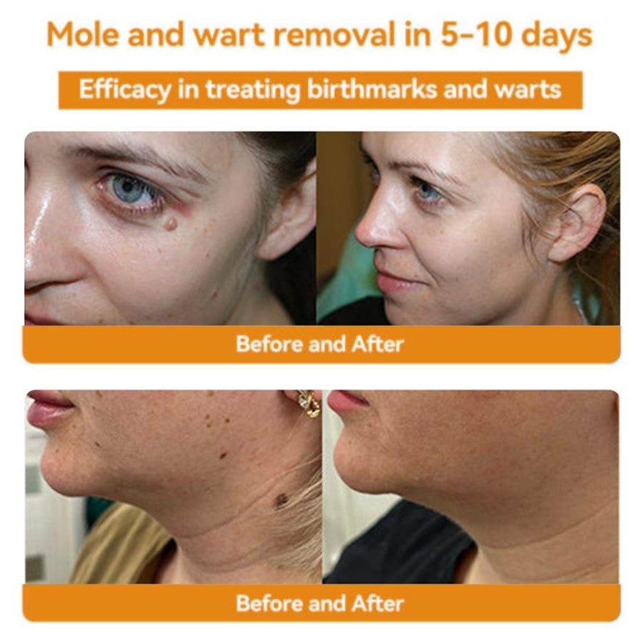 Fivfivgo™ Bee Venom Warts & Blemish Remover