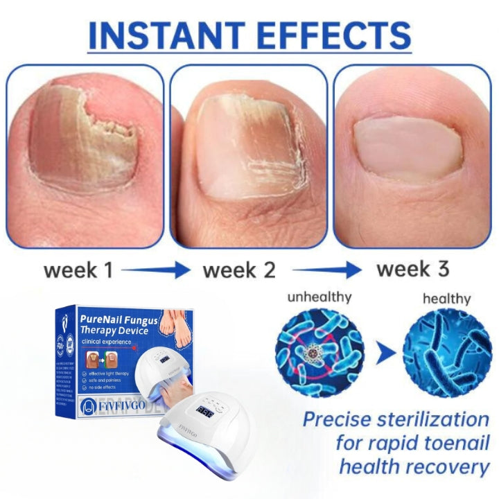 Fivfivgo™ PureNail Fungus Laser Therapy Device